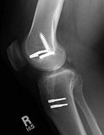 Anterior cruciate ligament fixation